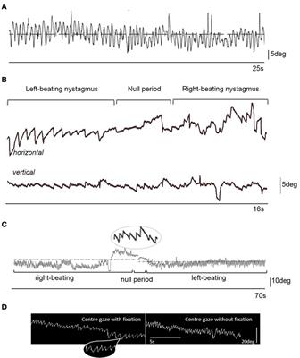 Adult Periodic Alternating Nystagmus Masked by Involuntary <mark class="highlighted">Head Movements</mark>